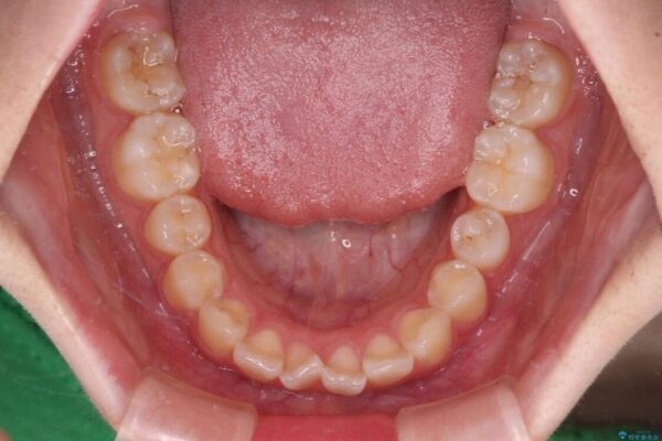 インビザラインは使える自信がない　ワイヤー装置にて矯正治療 治療前画像