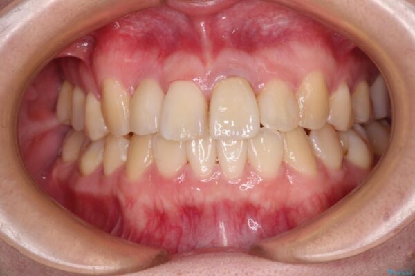 虫歯治療ついでに歯並びの後戻りを改善　インビザラインによる矯正治療 治療途中画像