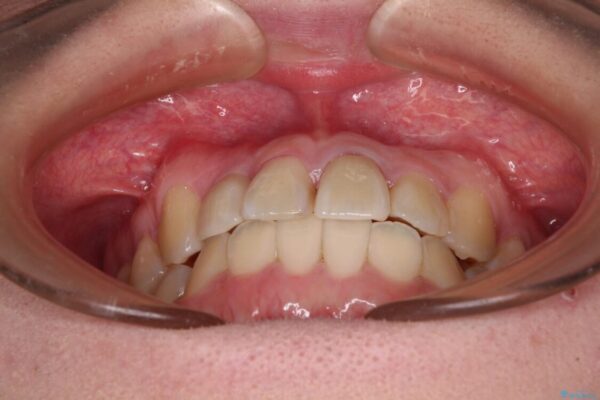 虫歯治療ついでに歯並びの後戻りを改善　インビザラインによる矯正治療 治療途中画像