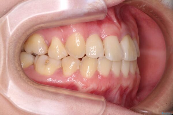 虫歯治療ついでに歯並びの後戻りを改善　インビザラインによる矯正治療 治療途中画像