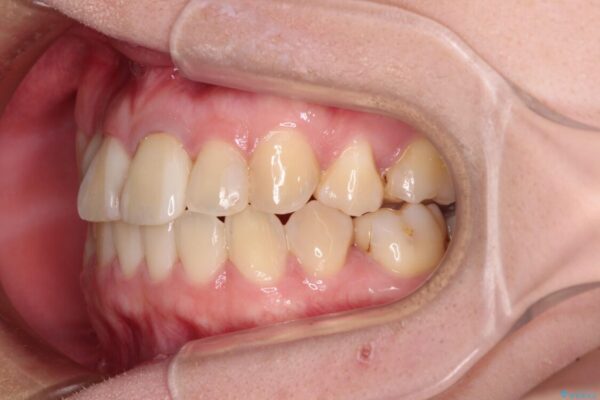 虫歯治療ついでに歯並びの後戻りを改善　インビザラインによる矯正治療 治療途中画像