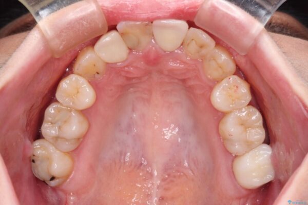 虫歯治療ついでに歯並びの後戻りを改善　インビザラインによる矯正治療 治療途中画像