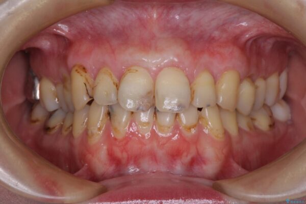 むし歯だらけの前歯をオールセラミッククラウンできれいに 治療途中画像