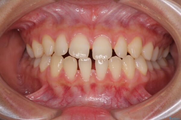隙間だらけの歯列　インビザラインで改善 治療前画像