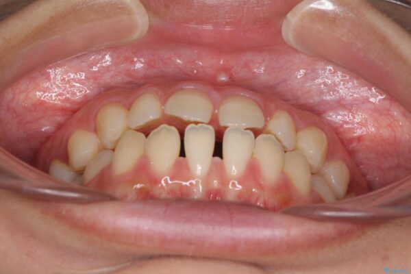 隙間だらけの歯列　インビザラインで改善 治療前画像