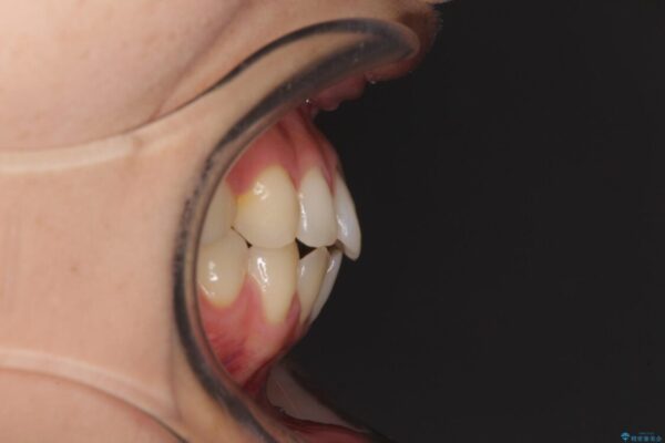 隙間だらけの歯列　インビザラインで改善 治療前画像