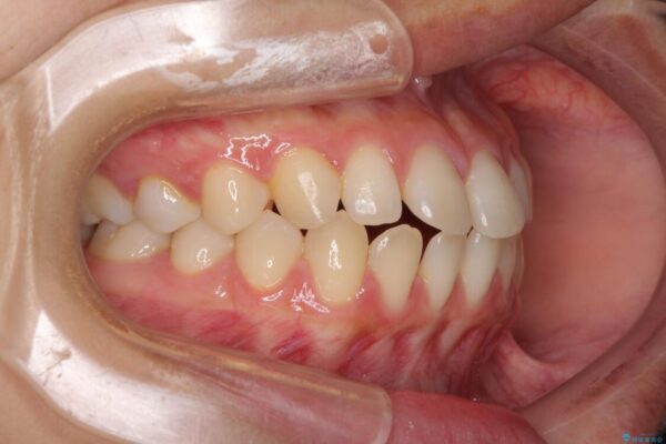 隙間だらけの歯列　インビザラインで改善 治療前画像