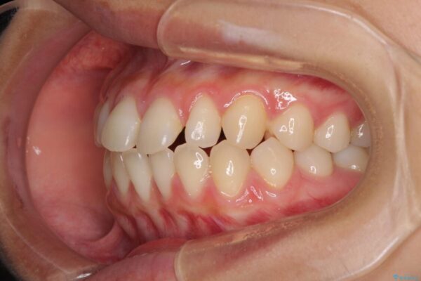 隙間だらけの歯列　インビザラインで改善 治療前画像
