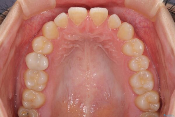 隙間だらけの歯列　インビザラインで改善 治療前画像