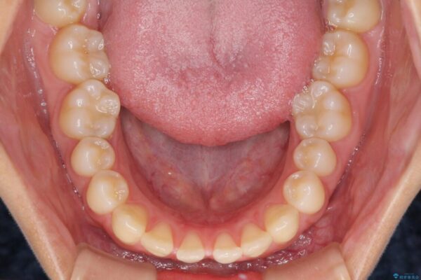 隙間だらけの歯列　インビザラインで改善 治療前画像