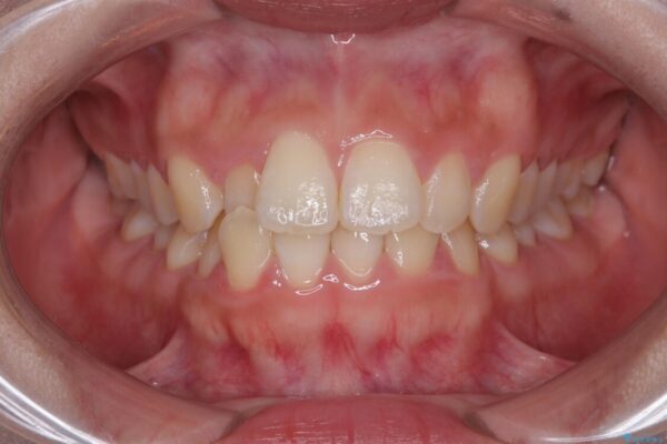 目立ちにくい表側装置で1年完了!狭いアーチを側方拡大し前歯のデコボコを整えた症例 治療前画像