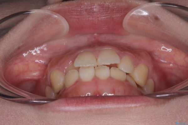 目立ちにくい表側装置で1年完了!狭いアーチを側方拡大し前歯のデコボコを整えた症例 治療前画像