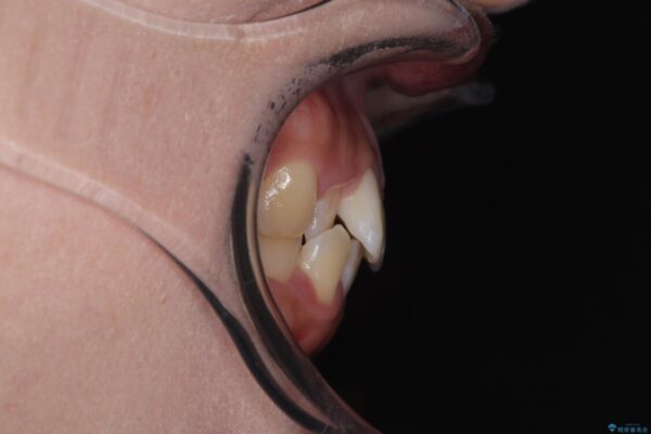 目立ちにくい表側装置で1年完了!狭いアーチを側方拡大し前歯のデコボコを整えた症例 ビフォー