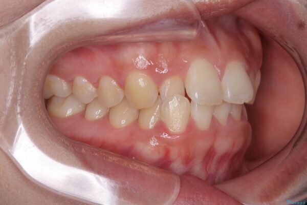 目立ちにくい表側装置で1年完了!狭いアーチを側方拡大し前歯のデコボコを整えた症例 治療前画像