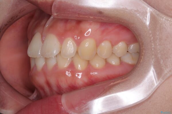 目立ちにくい表側装置で1年完了!狭いアーチを側方拡大し前歯のデコボコを整えた症例 治療前画像