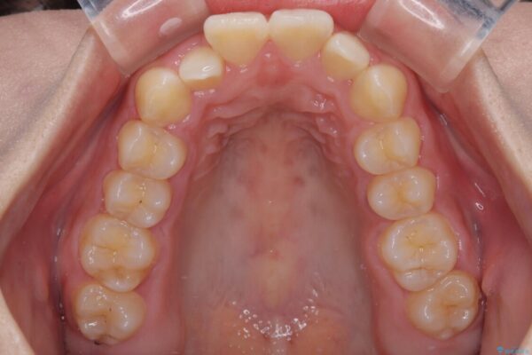 目立ちにくい表側装置で1年完了!狭いアーチを側方拡大し前歯のデコボコを整えた症例 治療前画像