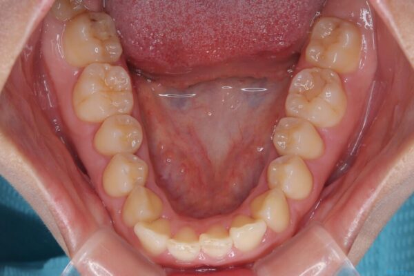 目立ちにくい表側装置で1年完了!狭いアーチを側方拡大し前歯のデコボコを整えた症例 治療前画像