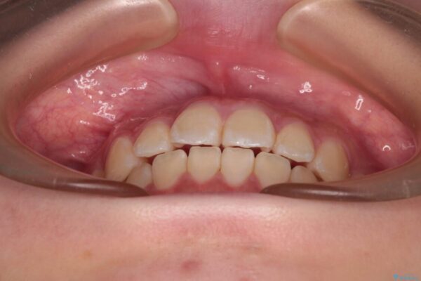 インビザラインは使える自信がない　ワイヤー装置にて矯正治療 治療後画像