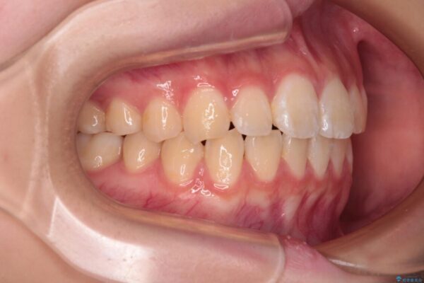 インビザラインは使える自信がない　ワイヤー装置にて矯正治療 治療後画像