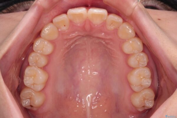 インビザラインは使える自信がない　ワイヤー装置にて矯正治療 治療後画像