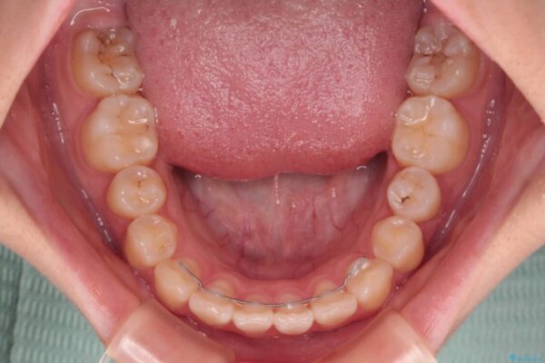 インビザラインは使える自信がない　ワイヤー装置にて矯正治療 治療後画像