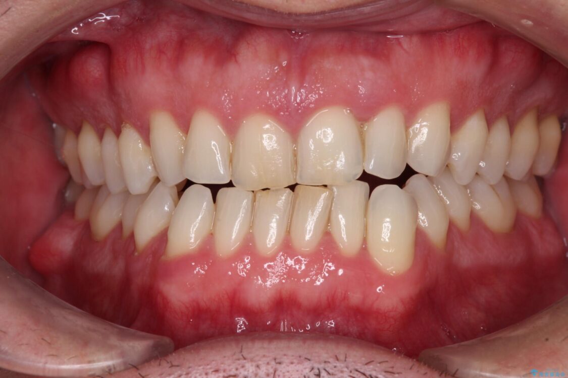 前歯でものを噛みきりたい　目立たない装置でのワイヤー矯正 治療前