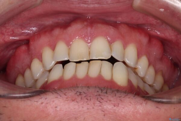 前歯でものを噛みきりたい　目立たない装置でのワイヤー矯正 治療前画像