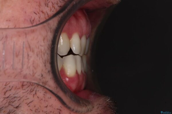 前歯でものを噛みきりたい　目立たない装置でのワイヤー矯正 治療前画像