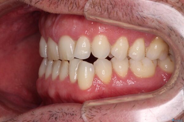 前歯でものを噛みきりたい　目立たない装置でのワイヤー矯正 治療前画像
