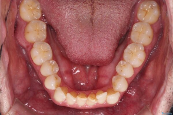 前歯でものを噛みきりたい　目立たない装置でのワイヤー矯正 治療前画像