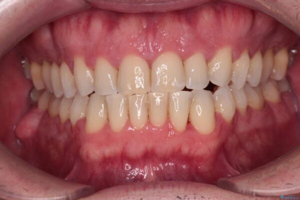 前歯でものを噛みきりたい　目立たない装置でのワイヤー矯正 治療後画像