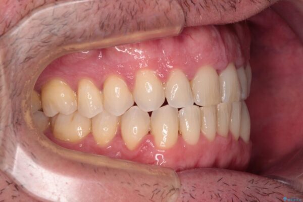 前歯でものを噛みきりたい　目立たない装置でのワイヤー矯正 治療後画像