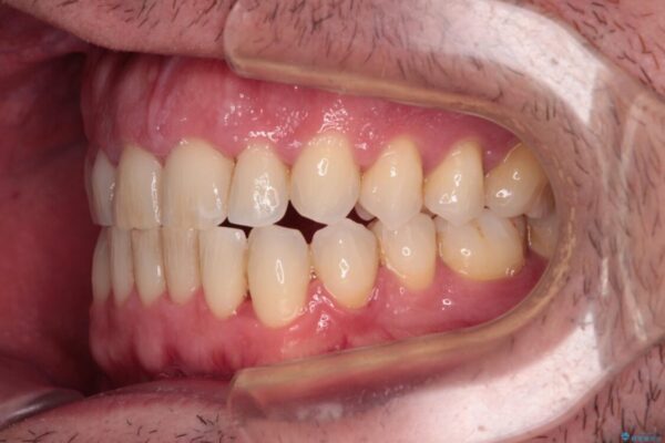 前歯でものを噛みきりたい　目立たない装置でのワイヤー矯正 治療後画像