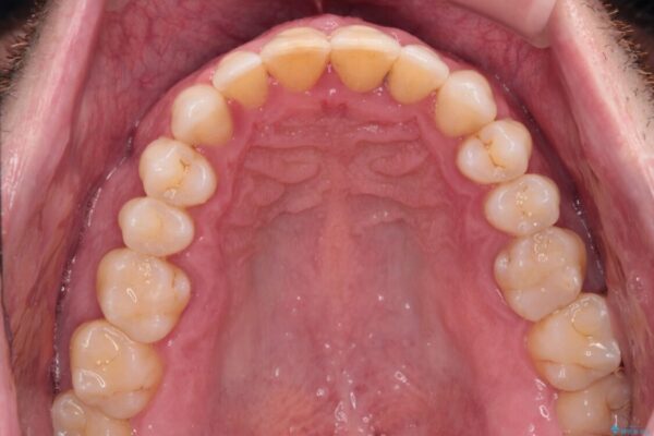 前歯でものを噛みきりたい　目立たない装置でのワイヤー矯正 治療後画像