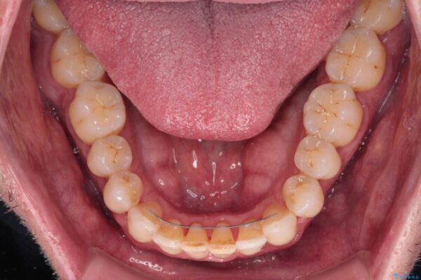 前歯でものを噛みきりたい　目立たない装置でのワイヤー矯正 治療後画像