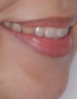 目立ちにくい表側装置で1年完了!狭いアーチを側方拡大し前歯のデコボコを整えた症例 治療後画像
