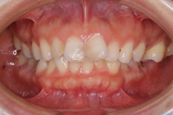 【モニター】出っ歯と咬み合わせを改善　ワイヤー装置の抜歯矯正 治療前画像