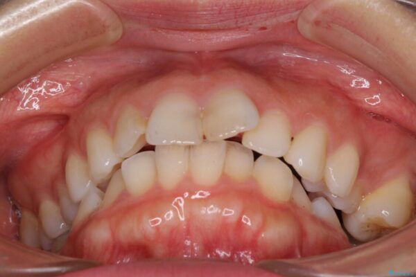 【モニター】出っ歯と咬み合わせを改善　ワイヤー装置の抜歯矯正 治療前画像