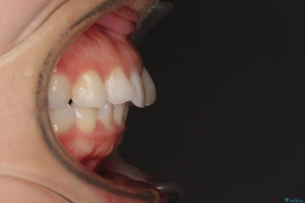 【モニター】出っ歯と咬み合わせを改善　ワイヤー装置の抜歯矯正 治療前画像