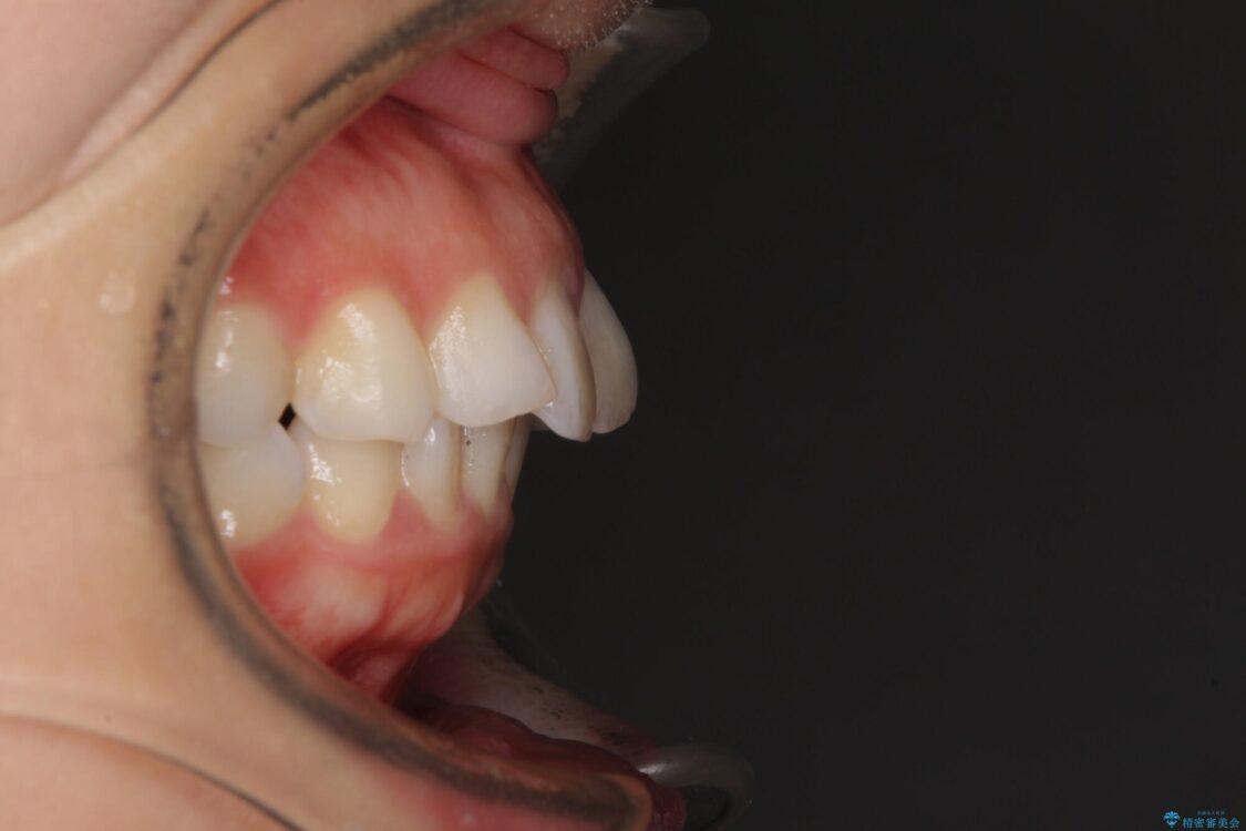 【モニター】出っ歯と咬み合わせを改善　ワイヤー装置の抜歯矯正 治療前