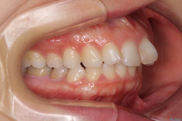【モニター】出っ歯と咬み合わせを改善　ワイヤー装置の抜歯矯正 治療前画像