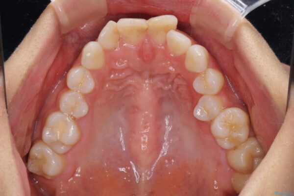 【モニター】出っ歯と咬み合わせを改善　ワイヤー装置の抜歯矯正 治療前画像