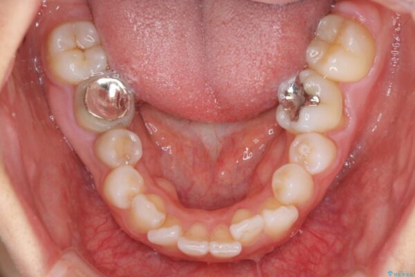 【モニター】出っ歯と咬み合わせを改善　ワイヤー装置の抜歯矯正 治療前画像