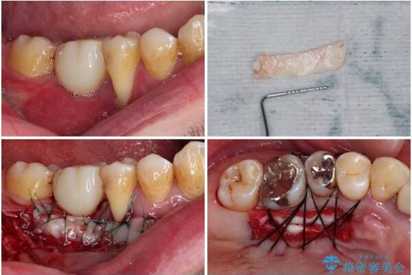 割れてしまった奥歯とデコボコの前歯　矯正治療とインプラント治療 治療途中画像