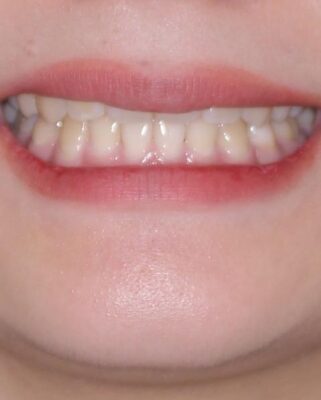 転勤でも安心して治療継続　抜歯スペース閉鎖と深い噛み合わせ改善のワイヤー矯正 治療後画像