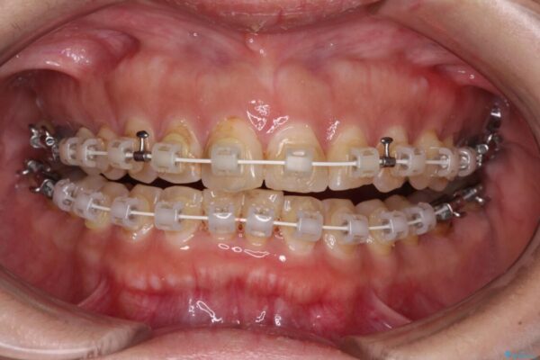【モニター】飛び出た前歯を整えたい　ワイヤー矯正治療 治療途中画像
