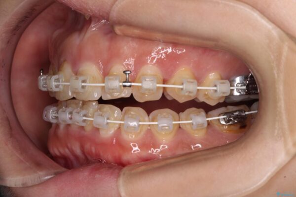 【モニター】飛び出た前歯を整えたい　ワイヤー矯正治療 治療途中画像