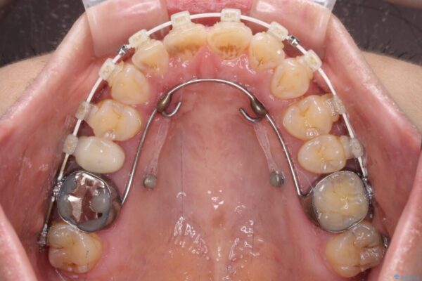 【モニター】飛び出た前歯を整えたい　ワイヤー矯正治療 治療途中画像