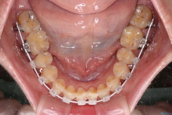 【モニター】飛び出た前歯を整えたい　ワイヤー矯正治療 治療途中画像
