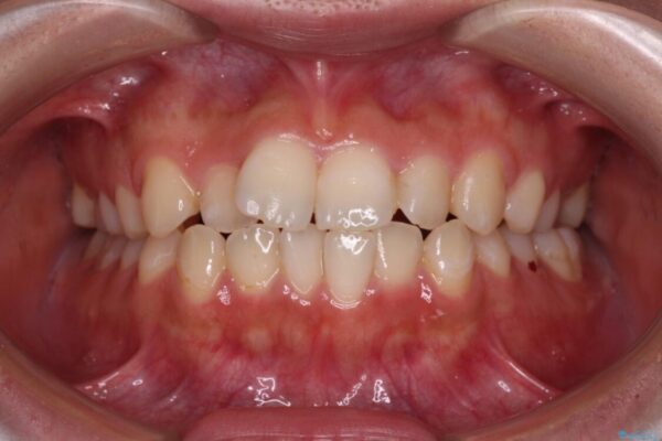 【モニター】短期間で終わりたい　ワイヤー装置での非抜歯矯正 ビフォー